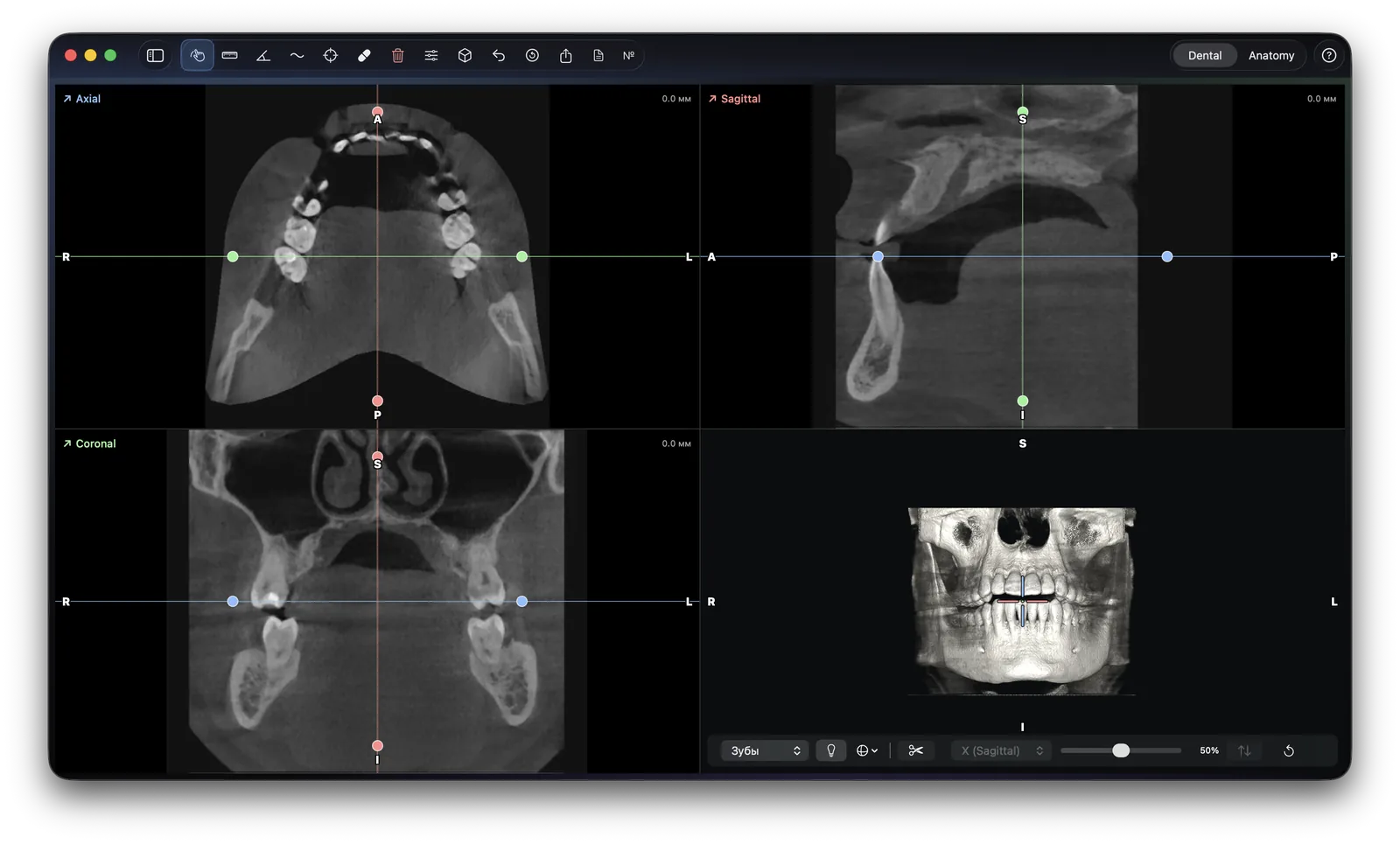 Главный экран Vidi: три проекции MPR — Axial, Sagittal, Coronal — и объёмная 3D-реконструкция черепа