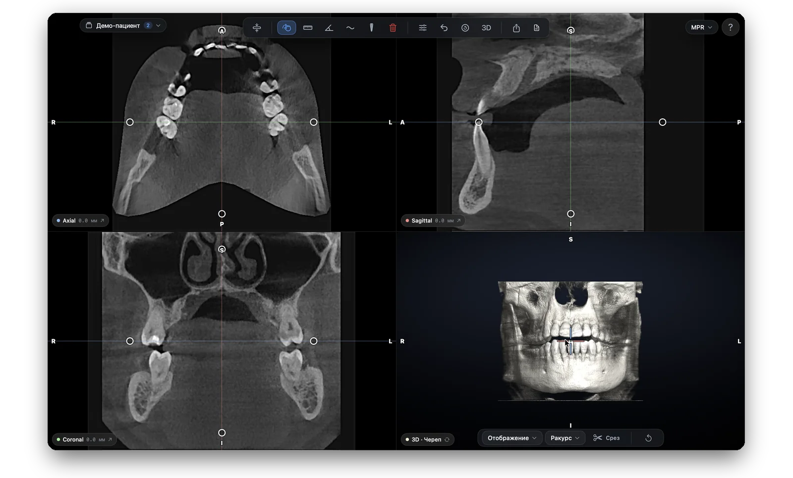 Три синхронные проекции MPR и 3D-реконструкция в Vidi